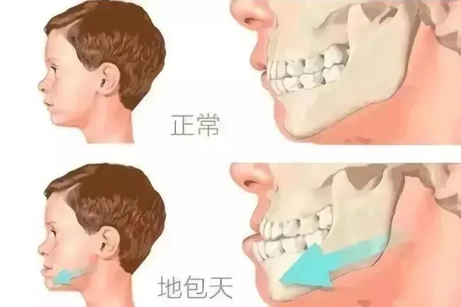 孩子牙齿“地包天”怎么办?植得口腔谷艳景医生科学解读